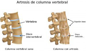 Artrosis-columna